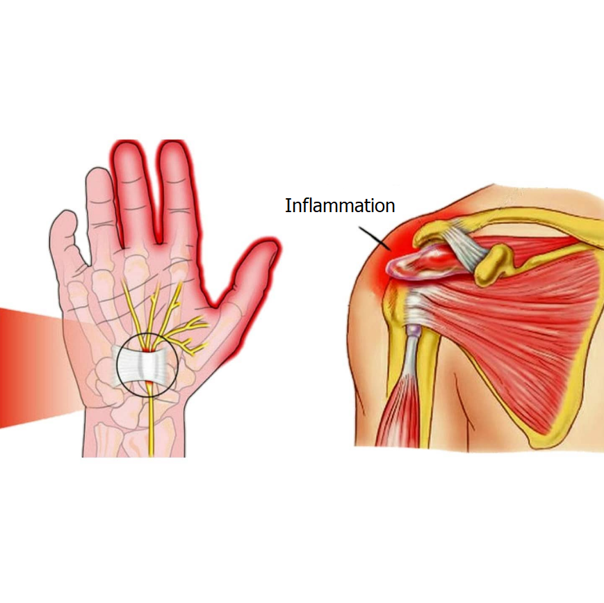 Inflammation Image