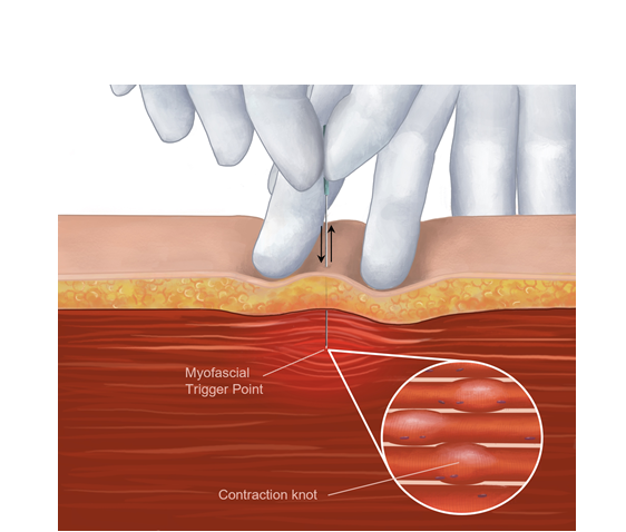 Dry Needling Image