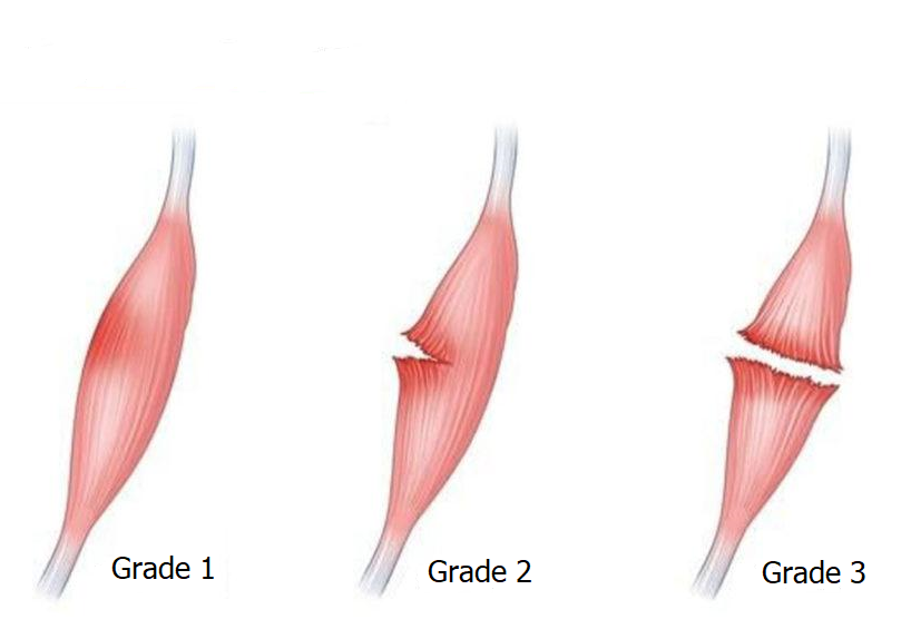 Muscle Strain Image